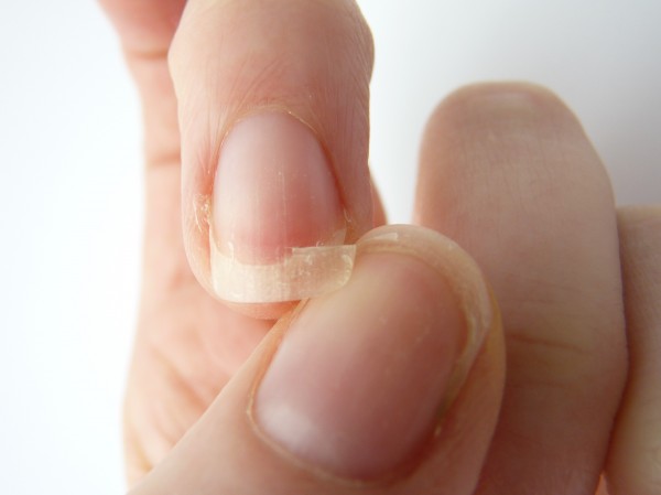 Infectii ale unghiilor si cum sa le evitam
