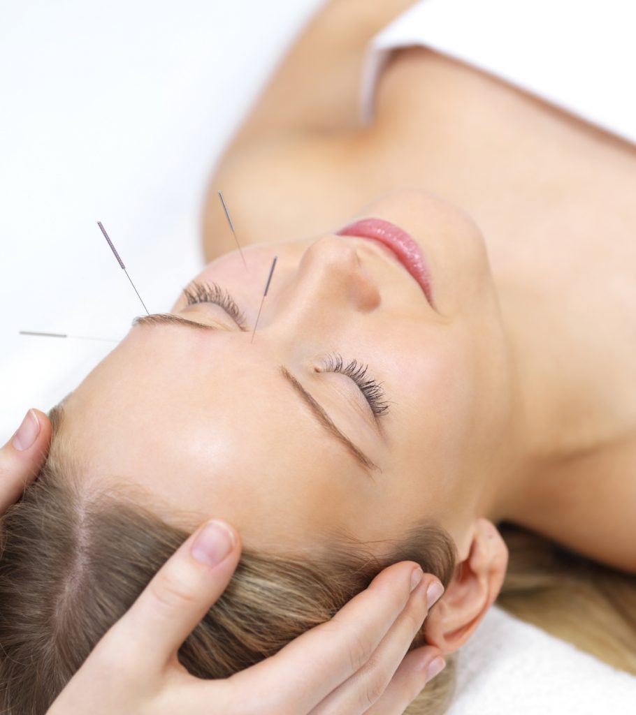 Acupunctura