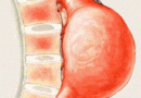 Anevrismul de aorta abdominala