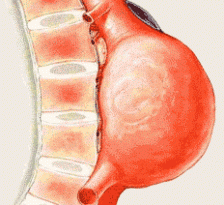 Anevrismul de aorta abdominala