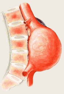 Anevrismul de aorta abdominala