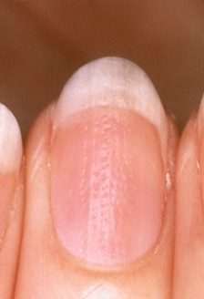 Tratament pentru dunga neagra pe unghii
